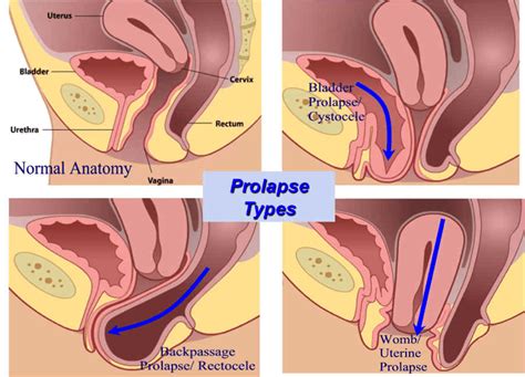 Colporrhaphy Prolapse Surgery