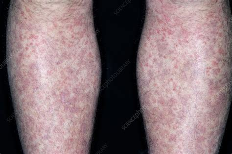 Allergic Purpura On The Legs Stock Image C0111678 Science Photo
