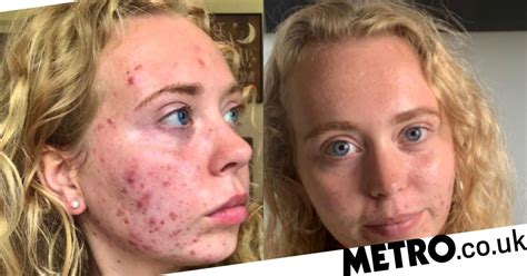 Woman Who Developed Acne At Nine Wont Let It Control Her Life Metro News