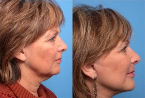 Facelift Before And After Pictures Case 93 Scottsdale Az Hobgood Facial Plastic Surgery