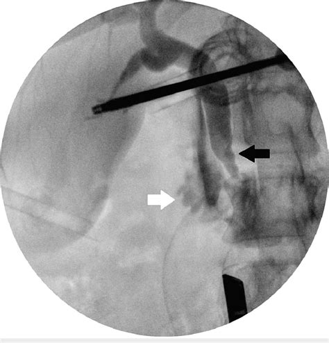 Intraoperative Cholangiogram Showing Free Flow Into The Duodenum White