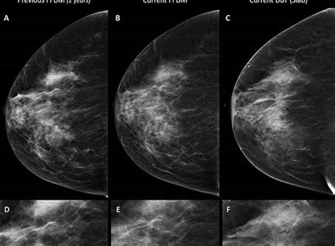 More Breast Cancers Found With Combined Digital Screening Axis
