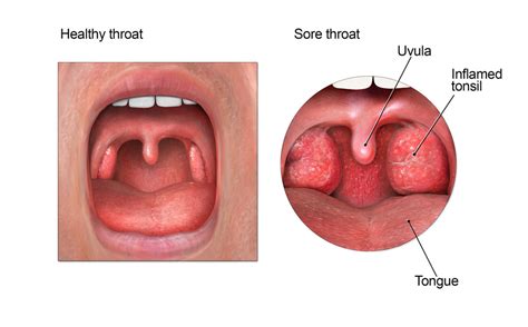 Healthy Healthy Tonsils Vs Unhealthy Pictures
