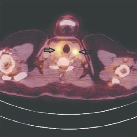 Pet Ct Scan With Arrows Showing Hypodense Lesions In Both Thyroid Lobes