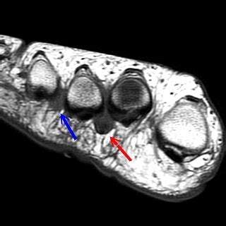 Check spelling or type a new query. Intermetatarsal Space