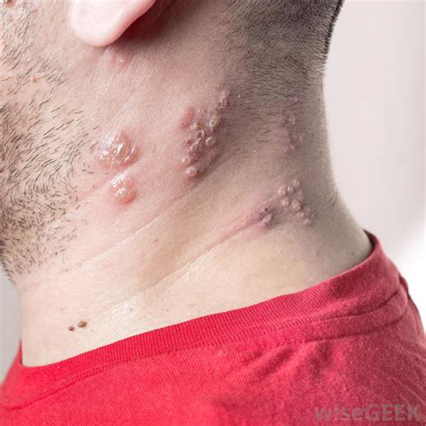 People Who Suffer From Lichen Planus Health Total
