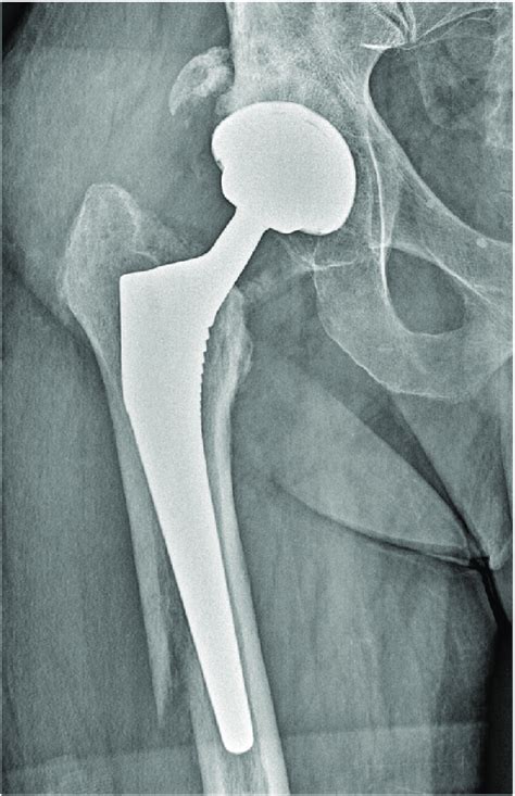 A At One Month Anteroposterior Hip X Ray With Periprosthetic Fracture