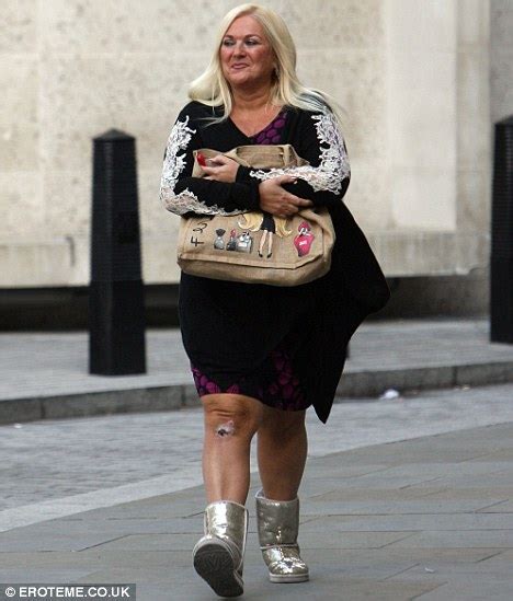 Vanessa Feltz Reveals Huge Scar After She Almost Loses Her Leg To A