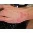 An Outbreak Of Scabies Hits Students In Oxford – The Student
