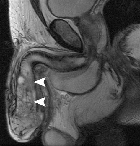 Imaging Of Penile Neoplasms Radiographics Sexiz Pix