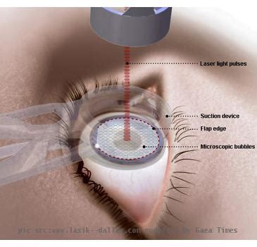 Revolutionary Lasik Technique Provides Super Vision