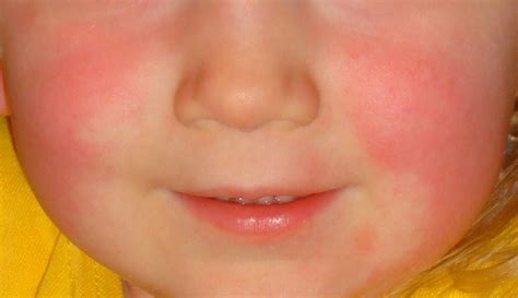 Numbered Rash Diseases Of Childhood Second Disease Scarlet Fever
