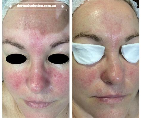 Rosacea Front View Before And After Prodermal Planning Treatments