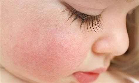 مشکلات پوستی کودکان خبرگزاری سلامت