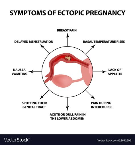 Symptoms Ectopic Pregnancy Infographics Royalty Free Vector