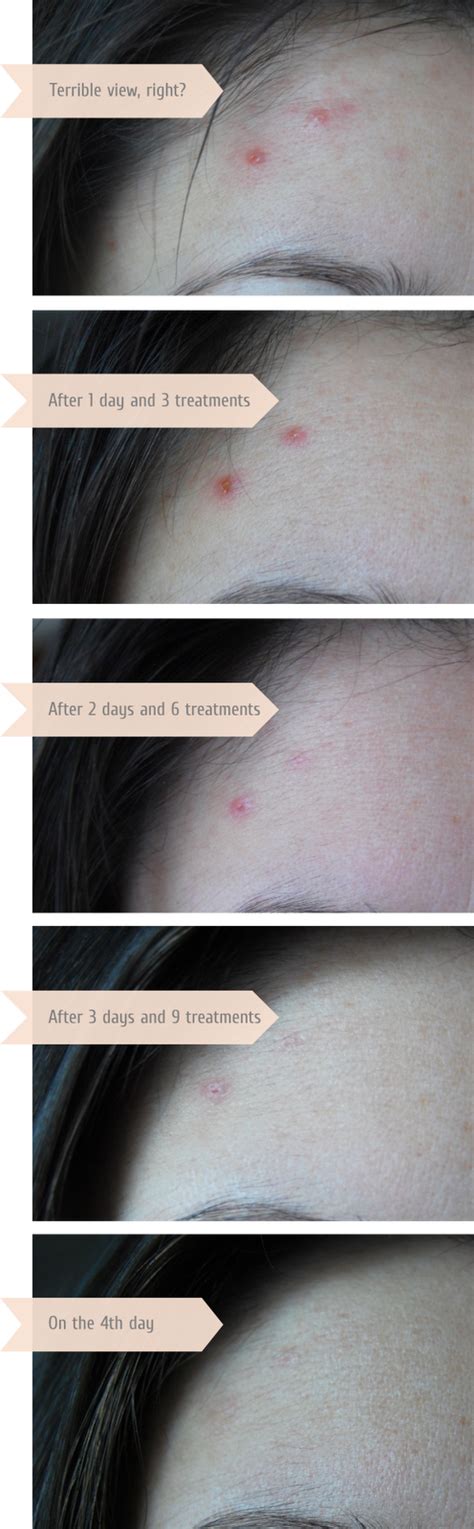 how to treat acne in 4 days with the help of banana peels pin now read later beauty and more