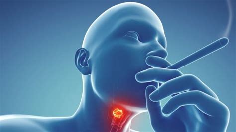 Throat Cancer Wetin Be Di Causes And Signs Of Throat Cancer Bbc News Pidgin