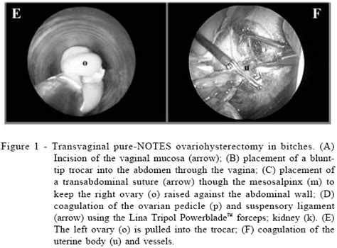 SciELO Brasil Pure Transvaginal Natural Orifice Transluminal Endoscopic Surgery NOTES