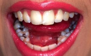 Signs and symptoms of mercury exposure. White fillings | an alternative to mercury