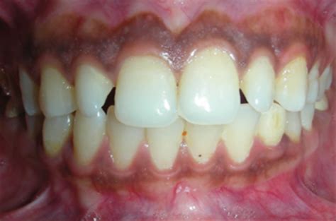 Clinical Photography A To Z APOS Trends In Orthodontics