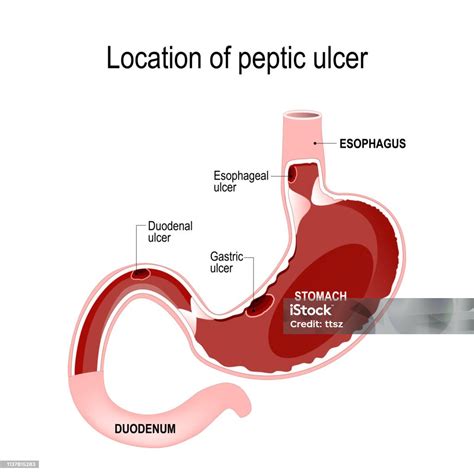 Location Of Peptic Ulcer Human Digestive System Esophagus Duodenum Stomach Arte Vetorial De
