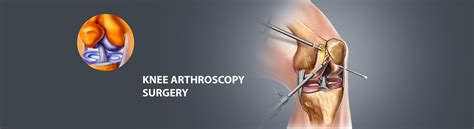 Check Out The Procedure Risk And Recovery Of Knee Arthroscopic Surgery