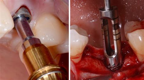 INTEGRATED IMPLANT REMOVAL PREDICTABLE PROTOCOL AND SAFE TECHNIQUE