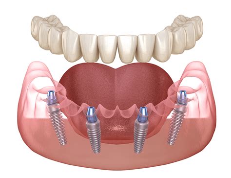 los algodones dental implants by dr jose moguel