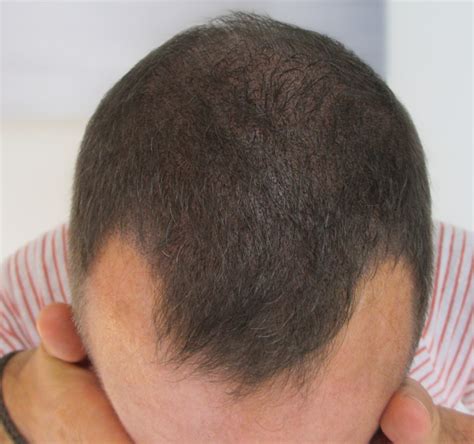 3 Main Hair Loss Types Skalp