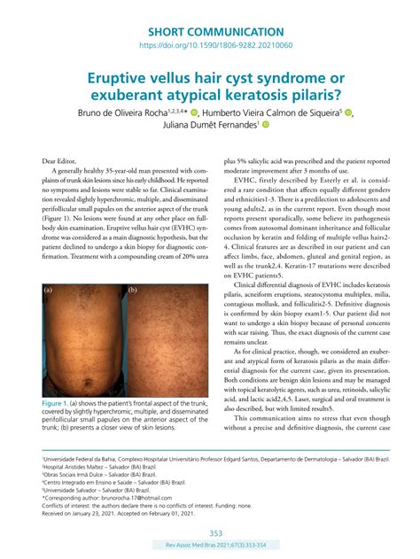 Pdf Eruptive Vellus Hair Cyst Syndrome Or Exuberant Atypical