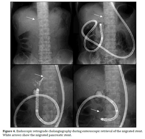 A Case Of Retrograde Migration Of Internal Pancreatic Stent From