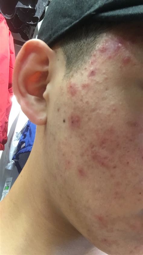 Moderate To Severe Acne Daily New Whiteheads General Acne