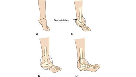 Deformity Correction Of Ankle And Foot Pune Foot Ankle