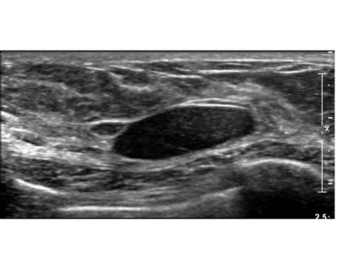 Online Cme Sonographic Evaluation Of Benign And Malignant Breast Masses