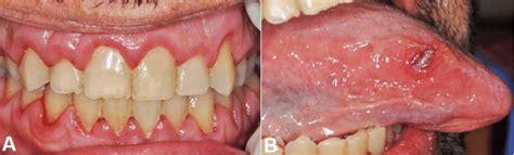 Oral Examination A Generalized Gingival Enlargement Associated With