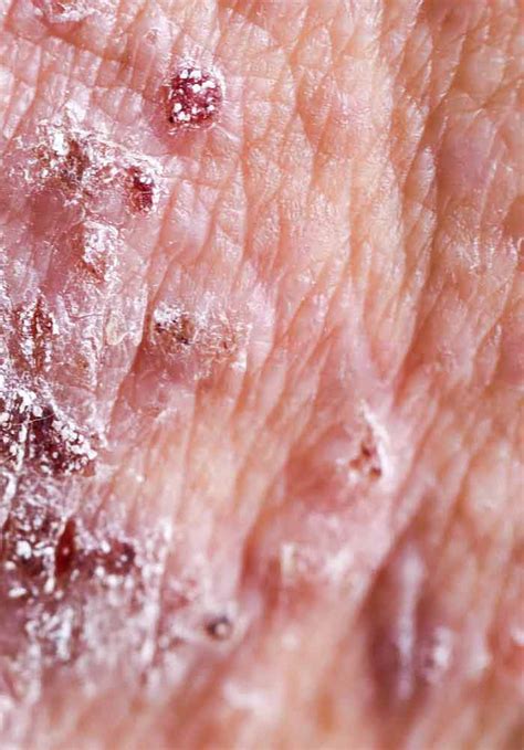 Treatment Of Psoriasis With Topical Agents Intechopen
