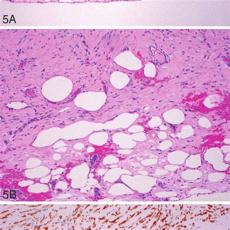 Mesothelioma is a cancer of the mesothelial cells that line a number of internal organs. Richard ATTANOOS | Medical Doctor | University of Wales ...
