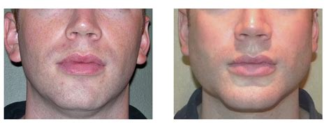 Chin And Jaw Angle Implants Image Courtesy Of Dr Bary Eppley