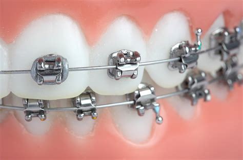 Understanding The Damon Braces Treatment Process Step By Step