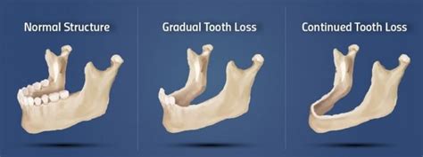 Bone Grafting Treatment By San Diego Periodontics And Implant Dentistry