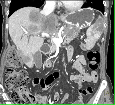 Pancreatic Adenocarcinoma With Liver Metastases And Splenic Infarcts