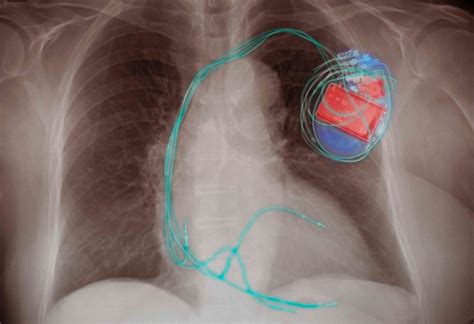 Complications With Implantable Defibrillators 2022