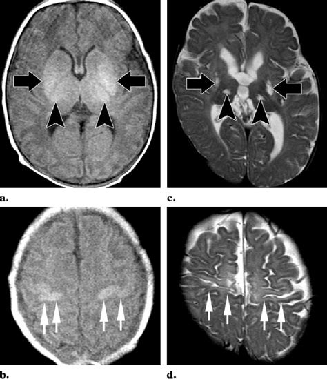 Figure 12 From Hypoxic Ischemic Brain Injury Imaging Findings From