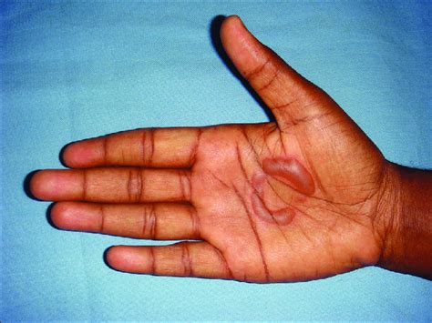 Ring Shaped Blister Burn On The Right Palm Download Scientific Diagram