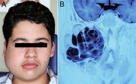Clinical And Imaging Features Of Extraskeletal Myxoid Chondrosarcoma