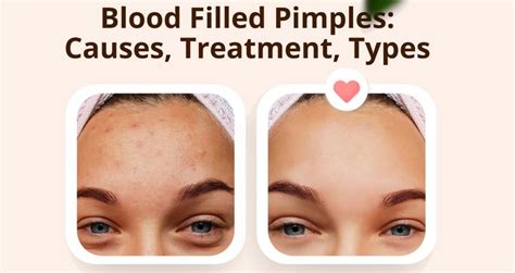 Blood Filled Pimples Causes Treatment And Types