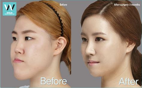 Look At Me Orangutan Woman Plastic Surgery Makeover