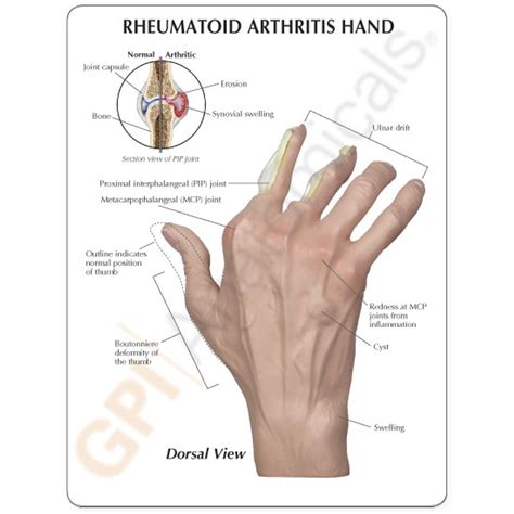 Hand Rheumatoid Arthritis Model Clinical Charts And Supplies