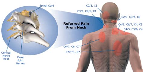 Cervicalgia Or Neck Pain What Are The Causes And Treatment Options