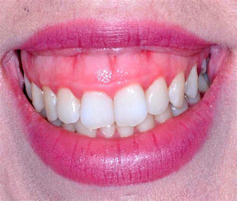 EstÉtica ¿cómo Tratar La Sonrisa Gingival Directorio Odontológico